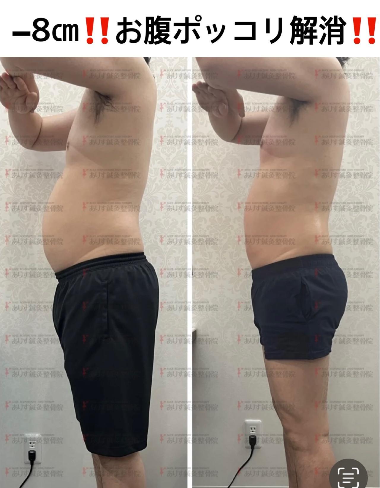 30代男性!1カ月後－8㎝！落ちにくいお腹周りも脂肪冷却でラク痩せ